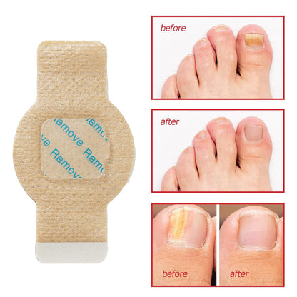 NailHeal™ - Fungal Nail Patches 🌿💅 ( Buy 1 Get 1 Free🔥🔥)